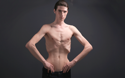 Identificando los síntomas de la anorexia